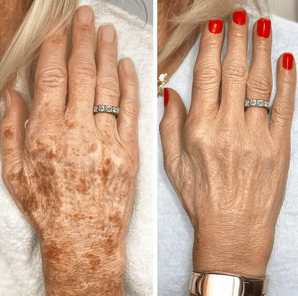 Top dark spot erasers that work