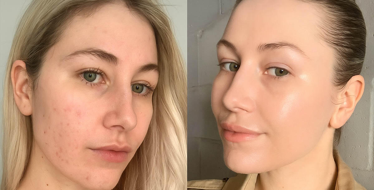 Woman with clear glowing skin after fixing sleep habit