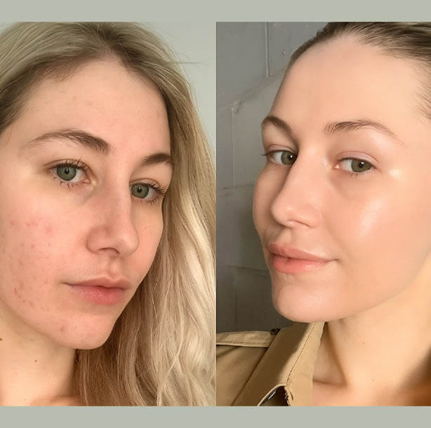 Fixed acne with sleep habit